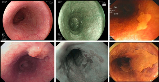上消化道内镜下食管粘膜病变示例